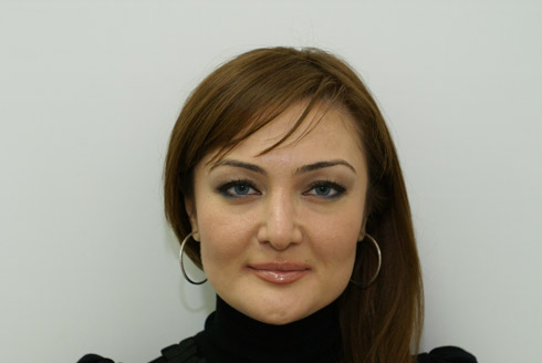 Фото после пластики носа, пластический хирург Салиджанов Анвар Шухратович