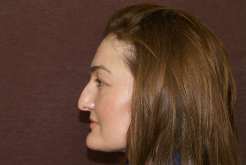 Фото до коррекции формы носа, пластический хирург Салиджанов Анвар Шухратович